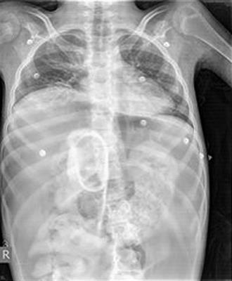 Gastric Necrosis and Perforation Following Massive Gastric Dilatation in an Adolescent Girl: A Rare Cause of Acute Abdomen